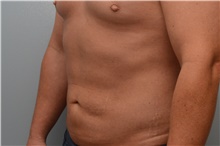 Liposuction After Photo by Carlos Rivera-Serrano, MD; Bay Harbour Islands, FL - Case 44613