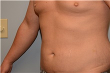 Liposuction Before Photo by Carlos Rivera-Serrano, MD; Bay Harbour Islands, FL - Case 44613