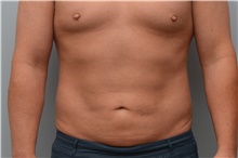 Liposuction After Photo by Carlos Rivera-Serrano, MD; Bay Harbour Islands, FL - Case 44613