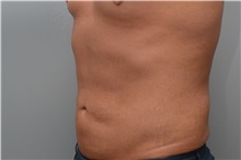 Liposuction After Photo by Carlos Rivera-Serrano, MD; Bay Harbour Islands, FL - Case 44613