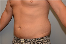 Liposuction Before Photo by Carlos Rivera-Serrano, MD; Bay Harbour Islands, FL - Case 44613