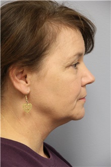 Facelift Before Photo by Carlos Rivera-Serrano, MD; Bay Harbour Islands, FL - Case 44614