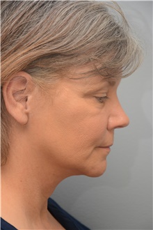 Facelift After Photo by Carlos Rivera-Serrano, MD; Bay Harbour Islands, FL - Case 44614