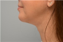 Chin Augmentation After Photo by Carlos Rivera-Serrano, MD; Miami Beach, FL - Case 44615