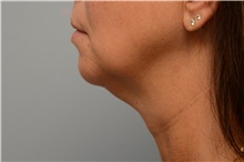 Chin Augmentation Before Photo by Carlos Rivera-Serrano, MD; Miami Beach, FL - Case 44615