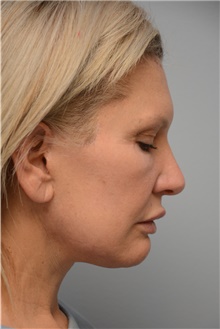 Facelift After Photo by Carlos Rivera-Serrano, MD; Carbondale, IL - Case 44616