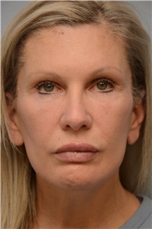 Facelift After Photo by Carlos Rivera-Serrano, MD; Carbondale, IL - Case 44616