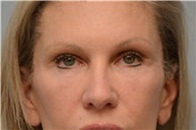 Eyelid Surgery After Photo by Carlos Rivera-Serrano, MD; Miami Beach, FL - Case 44617