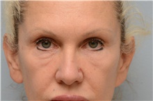 Eyelid Surgery Before Photo by Carlos Rivera-Serrano, MD; Bay Harbour Islands, FL - Case 44617