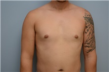 Male Breast Reduction After Photo by Carlos Rivera-Serrano, MD; Miami Beach, FL - Case 44618