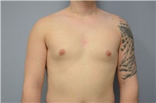 Male Breast Reduction Before Photo by Carlos Rivera-Serrano, MD; Miami Beach, FL - Case 44618