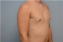Male Breast Reduction After Photo by Carlos Rivera-Serrano, MD; Bay Harbour Islands, FL - Case 44618