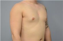 Male Breast Reduction Before Photo by Carlos Rivera-Serrano, MD; Bay Harbour Islands, FL - Case 44618