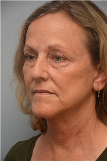 Facelift After Photo by Carlos Rivera-Serrano, MD; Bay Harbour Islands, FL - Case 44730