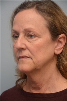Facelift Before Photo by Carlos Rivera-Serrano, MD; Bay Harbour Islands, FL - Case 44731