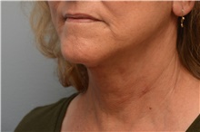 Facelift After Photo by Carlos Rivera-Serrano, MD; Bay Harbour Islands, FL - Case 44731