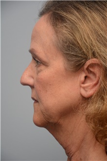 Facelift Before Photo by Carlos Rivera-Serrano, MD; Bay Harbour Islands, FL - Case 44731