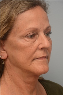 Facelift After Photo by Carlos Rivera-Serrano, MD; Bay Harbour Islands, FL - Case 44731