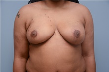 Breast Reconstruction After Photo by Carlos Rivera-Serrano, MD; Carbondale, IL - Case 44732