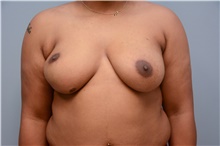 Breast Reconstruction Before Photo by Carlos Rivera-Serrano, MD; Carbondale, IL - Case 44732
