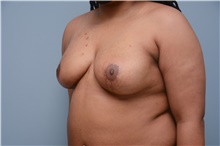 Breast Reconstruction After Photo by Carlos Rivera-Serrano, MD; Bay Harbour Islands, FL - Case 44732
