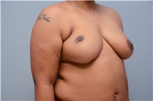 Breast Reconstruction Before Photo by Carlos Rivera-Serrano, MD; Bay Harbour Islands, FL - Case 44732