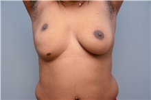 Breast Reconstruction Before Photo by Carlos Rivera-Serrano, MD; Bay Harbour Islands, FL - Case 44732