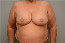 Breast Reconstruction After Photo by Carlos Rivera-Serrano, MD; Carbondale, IL - Case 44733