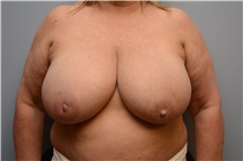 Breast Reconstruction Before Photo by Carlos Rivera-Serrano, MD; Carbondale, IL - Case 44733