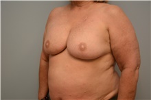 Breast Reconstruction After Photo by Carlos Rivera-Serrano, MD; Bay Harbour Islands, FL - Case 44733