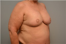 Breast Reconstruction Before Photo by Carlos Rivera-Serrano, MD; Bay Harbour Islands, FL - Case 44733