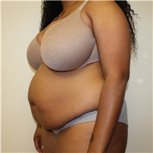 Tummy Tuck Before Photo by Kyle Shaddix, MD; Pensacola, FL - Case 31986