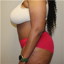 Tummy Tuck After Photo by Kyle Shaddix, MD; Pensacola, FL - Case 31986