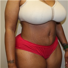 Tummy Tuck After Photo by Kyle Shaddix, MD; Pensacola, FL - Case 31986