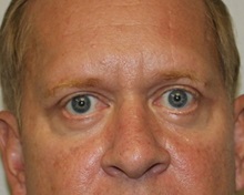 Eyelid Surgery After Photo by Kyle Shaddix, MD; Pensacola, FL - Case 35965