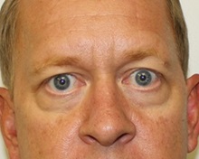 Eyelid Surgery Before Photo by Kyle Shaddix, MD; Pensacola, FL - Case 35965