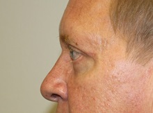Eyelid Surgery After Photo by Kyle Shaddix, MD; Pensacola, FL - Case 35965