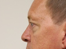 Eyelid Surgery Before Photo by Kyle Shaddix, MD; Pensacola, FL - Case 35965