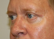 Eyelid Surgery After Photo by Kyle Shaddix, MD; Pensacola, FL - Case 35965