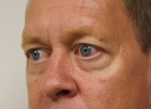Eyelid Surgery Before Photo by Kyle Shaddix, MD; Pensacola, FL - Case 35965