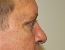 Eyelid Surgery After Photo by Kyle Shaddix, MD; Pensacola, FL - Case 35965