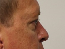 Eyelid Surgery Before Photo by Kyle Shaddix, MD; Pensacola, FL - Case 35965