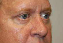 Eyelid Surgery After Photo by Kyle Shaddix, MD; Pensacola, FL - Case 35965