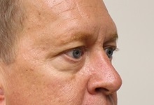 Eyelid Surgery Before Photo by Kyle Shaddix, MD; Pensacola, FL - Case 35965