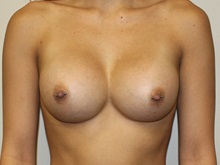 Breast Augmentation After Photo by Kyle Shaddix, MD; Pensacola, FL - Case 35967