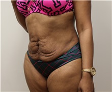 Tummy Tuck Before Photo by Kyle Shaddix, MD; Pensacola, FL - Case 35976