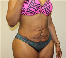 Tummy Tuck Before Photo by Kyle Shaddix, MD; Pensacola, FL - Case 35976