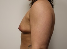 Breast Augmentation Before Photo by Kyle Shaddix, MD; Pensacola, FL - Case 35984