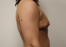 Breast Augmentation Before Photo by Kyle Shaddix, MD; Pensacola, FL - Case 35984
