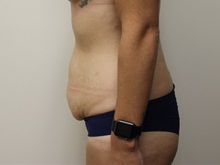 Tummy Tuck Before Photo by Kyle Shaddix, MD; Pensacola, FL - Case 35995